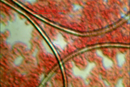 Vércseppanalízis: keresztcsontgyulladás vélhető oka is a parazita